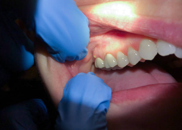 Best Chipped Tooth Repair Near Me  in Blackshear, GA